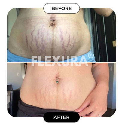 FLEXURA Ultrasonic Cavitation