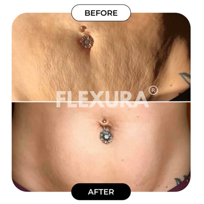 FLEXURA Ultrasonic Cavitation